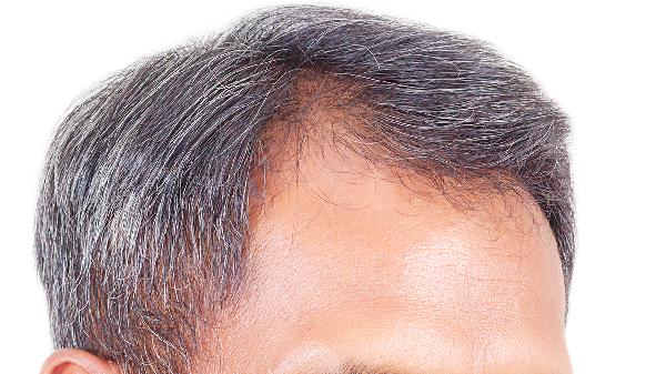 为什么出现斑秃