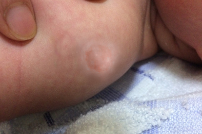 泡什么喝可以治脂肪瘤