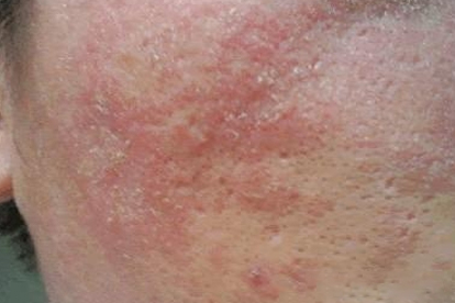 脂溢性皮炎用哪些藥好