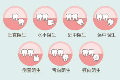 智齒發(fā)炎中把智齒拔了