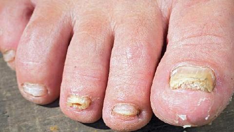 儿童咬指甲怎么矫正