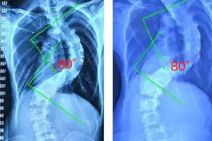 脊柱側(cè)彎是怎么回事