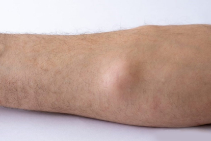 脂肪瘤手術(shù)到底多少錢(qián)