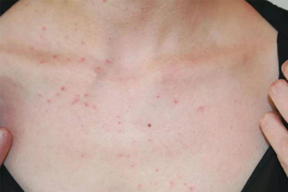 脂溢性皮炎去哪里治療