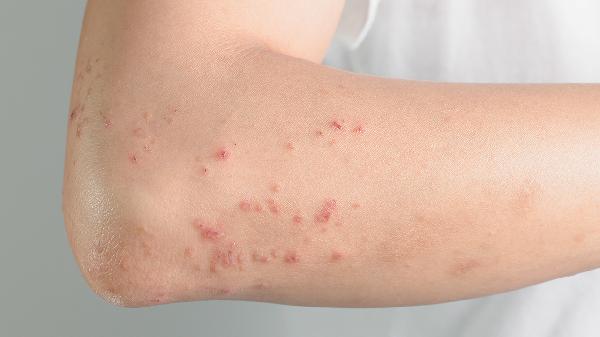 治療血小板紫癜多少錢(qián)