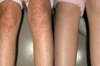 紫癜患者能锻炼身体吗