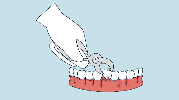 拔牙后缝针注意事项