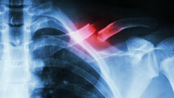 病理性骨折什么意思