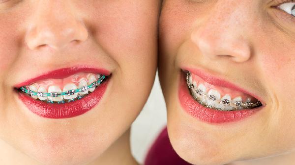 戴牙套會影響臉型嗎
