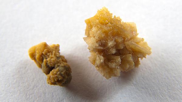 結(jié)石在腎里能碎石嗎