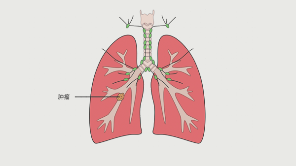 咳嗽嗓子痒会不会肺炎