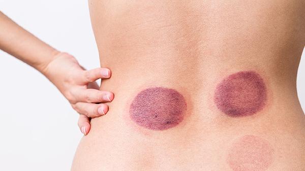 拔罐一般拔幾分鐘